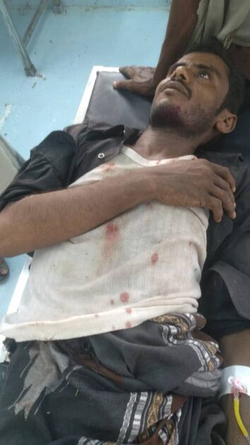 إصابة مواطن بانفجار لغم من مخلفات الحوثيين في حيس