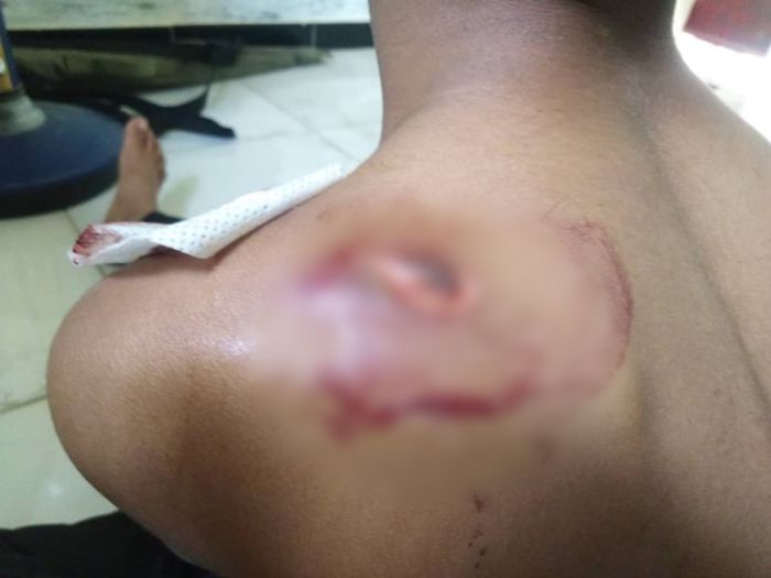 إصابة طفلين شقيقين برصاص قناص حوثي في تعز