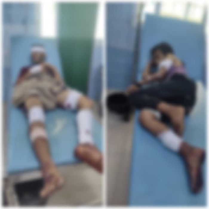 إصابات بالغة لشقيقين بانفجار عبوة ناسفة من مخلفات الحوثي في تعز