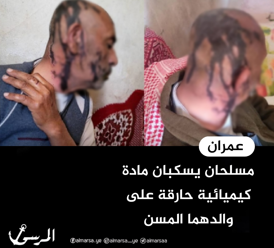 مسلحان يسكبان مادة كيميائية حارقة على والدهما المسن في عمران