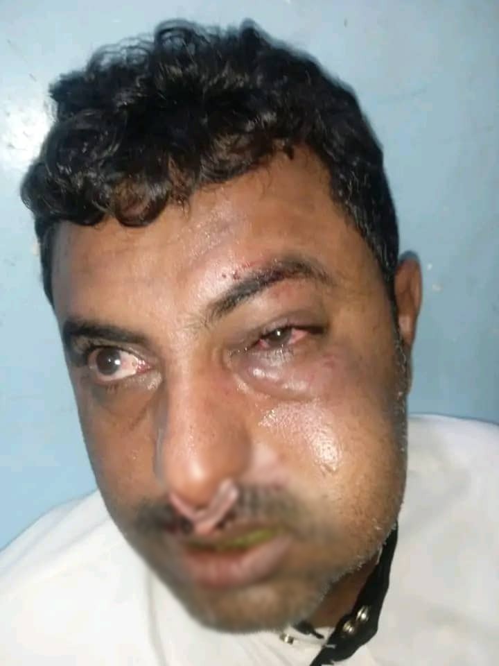 قيادي حوثي يعتدي بالضرب على محامٍ في مدينة زبيد بالحديدة