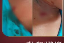 إصابة طفلة برصاص قناص حوثي في مديرية مقبنة غربي تعز