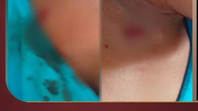 إصابة طفلة برصاص قناص حوثي في مديرية مقبنة غربي تعز